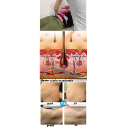 Lipo Laser – Profesjonalne Wyszczuplanie i Ujędrnianie
